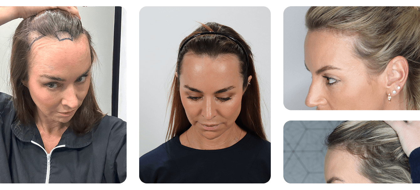 women-hair-loss-alvi-armani