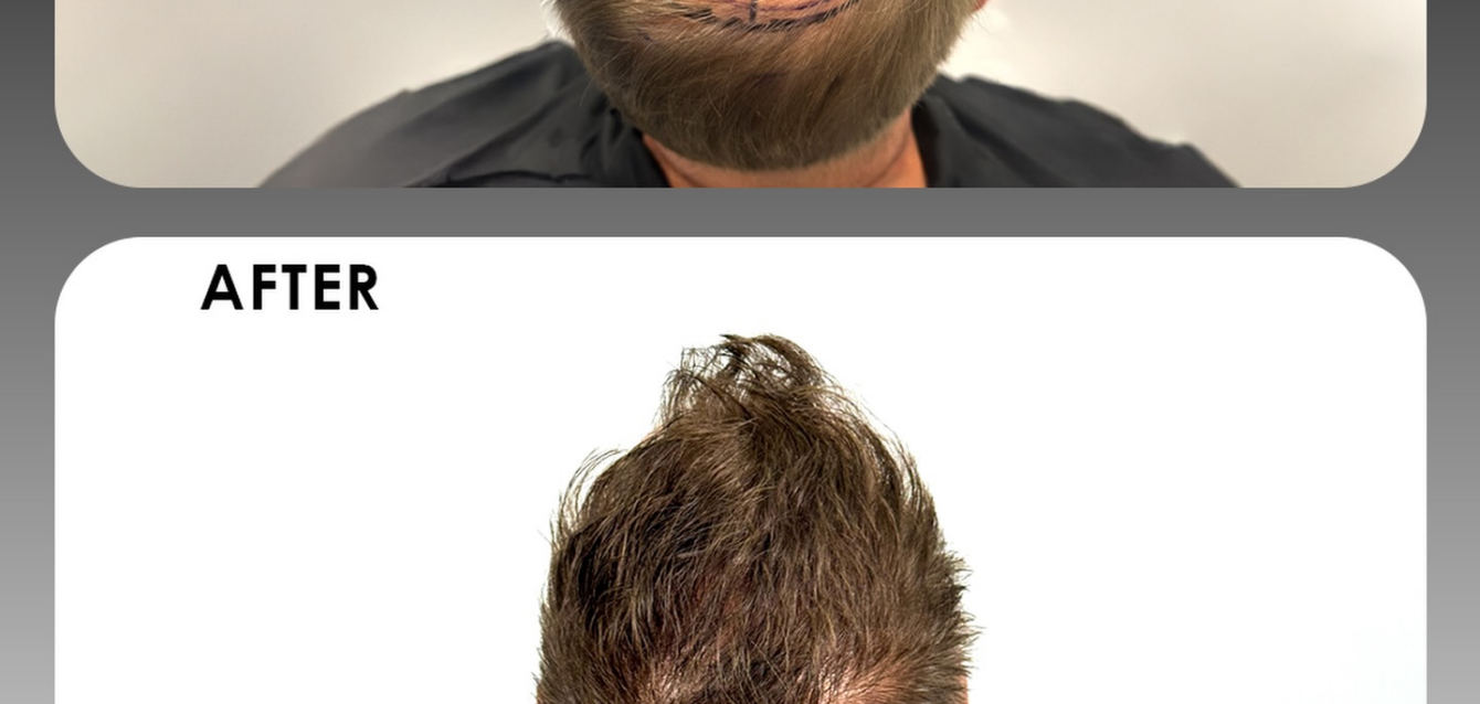 How Many Grafts Do You Need? Hair Graft Calculator Guide – Alvi Armani South Africa